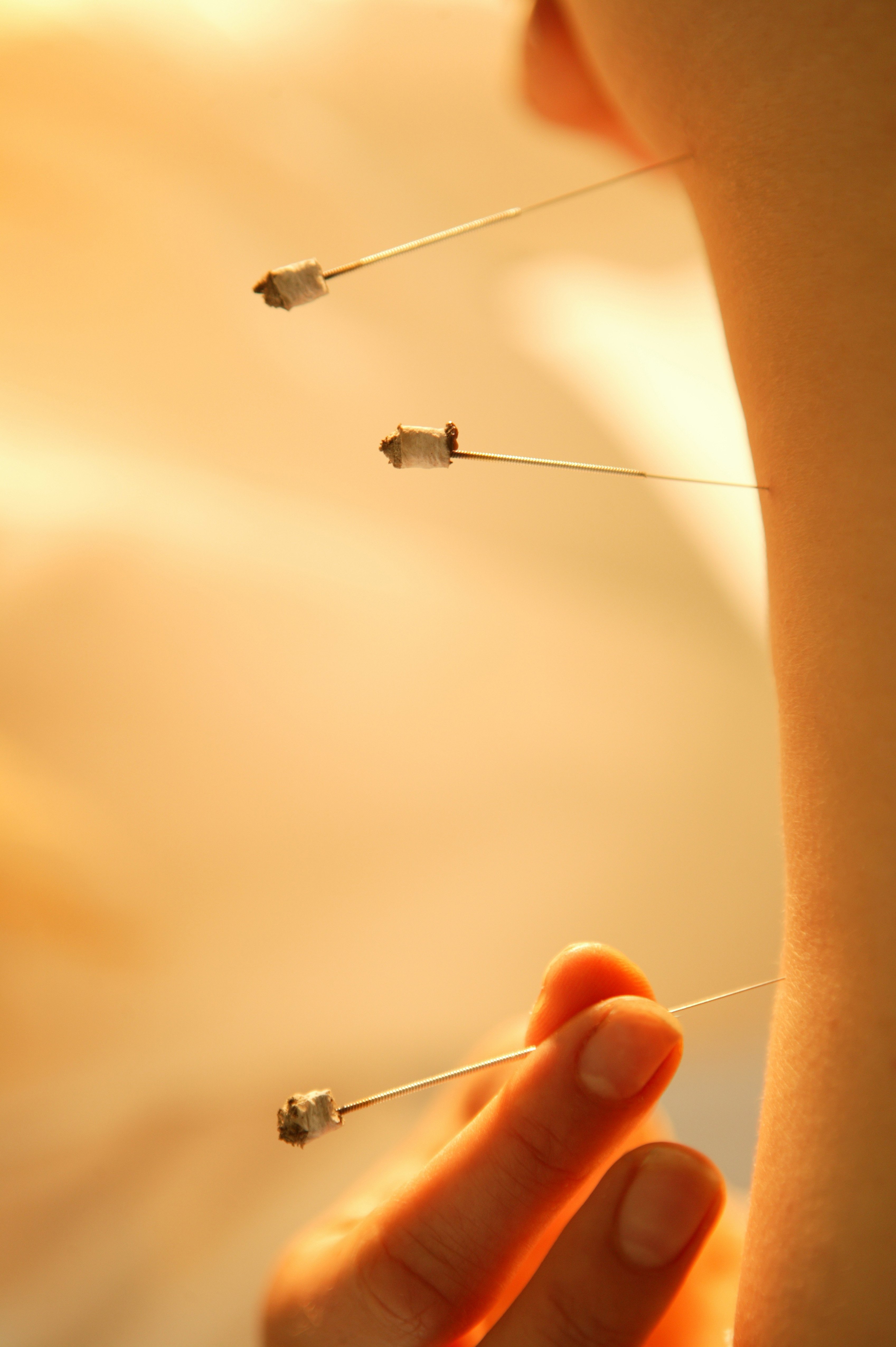 Mange danskere benytter sig af alternative behandlingsformer som akupunktur.
