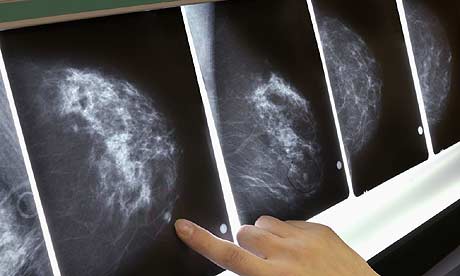 A mammographic image to detect breast cancer