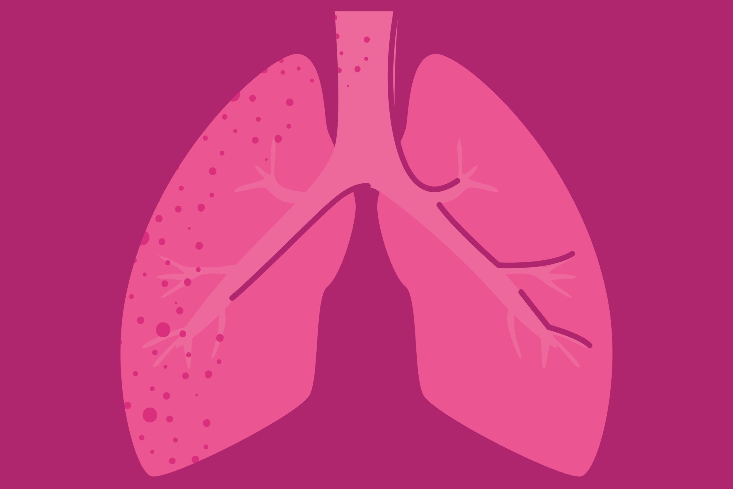 Lægerne håber at kunne udpege de kendetegn, som de hårdest ramte patienter har til fælles. Det kan måske vise sig at være antallet af hvide blodlegemer, brug af bestemte lægemidler eller noget tredje.